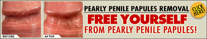 Treatment pearly natural penile papules How to