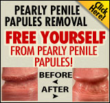 Pearly Penile Papules Removal